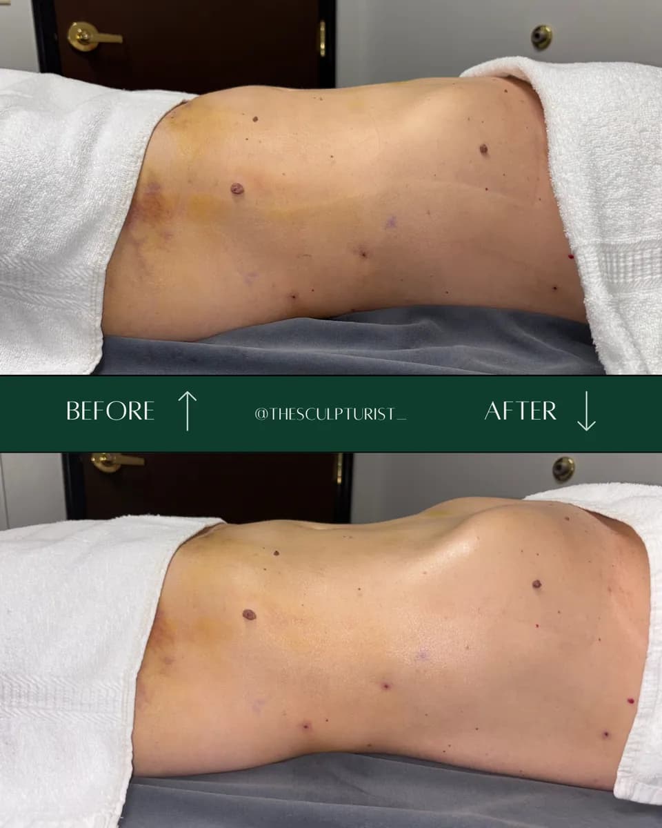 Before and after lymphatic drainage results